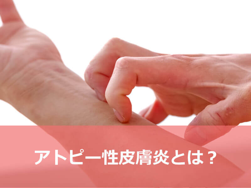 アトピー性皮膚炎とは？