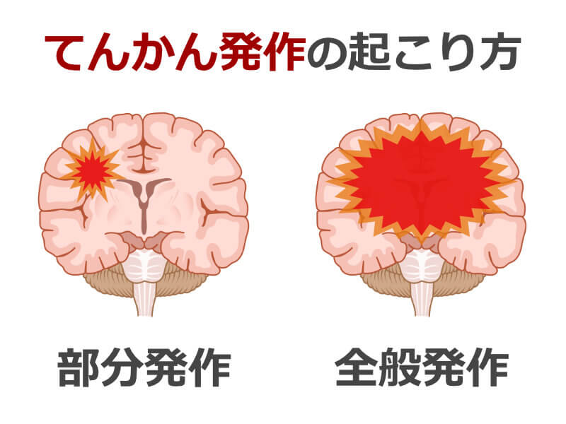 てんかん発作の種類