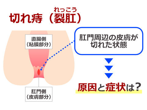 切れ痔（裂肛）の原因と症状とは？