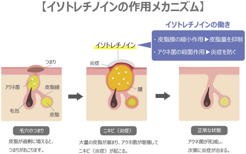 ニキビ メカニズム