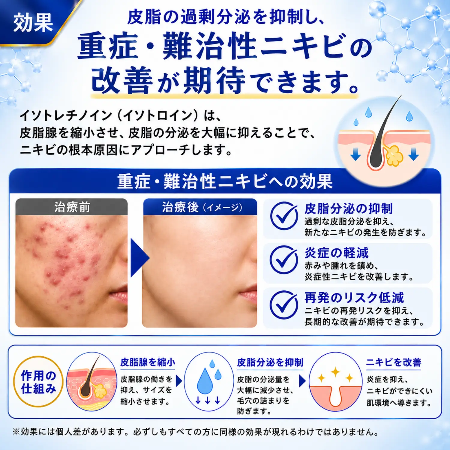 イソトレチノイン（イソトロイン）